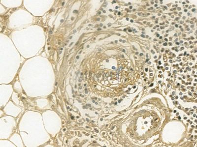 Cytokeratin 2e Mouse Monoclonal Antibody - BF8605 at 1/100 staining human pancreatic cancer and para-carcinoma tissue by IHC-P.