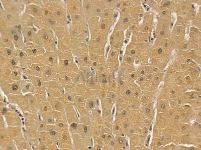 Estrogen-induced gene 121 protein Mouse Monoclonal Antibody - BF8622 at 1/100 staining human prostate cancer by IHC-P.