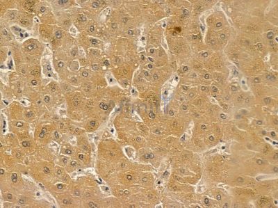 Estrogen-induced gene 121 protein Mouse Monoclonal Antibody - BF8622 at 1/100 staining human liver cancer by IHC-P.