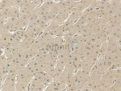 FAM114A2 Mouse Monoclonal Antibody - BF8634 at 1/100 staining human prostate cancer and para-carcinoma tissue by IHC-P.