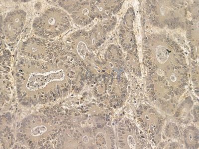 FAM114A2 Mouse Monoclonal Antibody - BF8634 at 1/100 staining human prostate cancer by IHC-P.