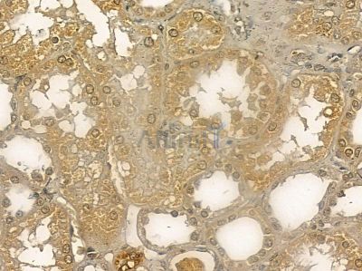CEP27 Mouse Monoclonal Antibody - BF8644 at 1/100 staining human pancreatic cancer by IHC-P.