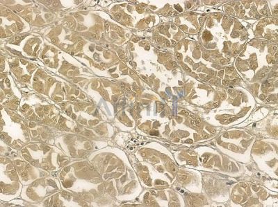 CEP27 Mouse Monoclonal Antibody - BF8644 at 1/100 staining human renal cell carcinoma by IHC-P.