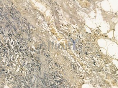 C1QTNF9B Mouse Monoclonal Antibody - BF8647 at 1/100 staining human small cell lung carcinoma by IHC-P.