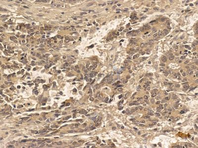 SCNM1 Mouse Monoclonal Antibody - BF8652 at 1/100 staining human prostate cancer by IHC-P.
