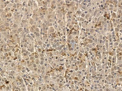 C1QTNF1 Mouse Monoclonal Antibody - BF8665 at 1/100 staining human gastric cancer by IHC-P.