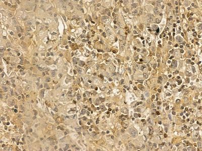 MED13L Mouse Monoclonal Antibody - BF8666 at 1/100 staining human gastric cancer by IHC-P.