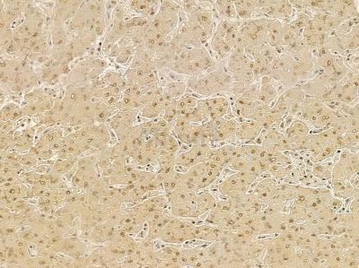 MXD4 Mouse Monoclonal Antibody - BF8669 at 1/100 staining human liver cancer by IHC-P.