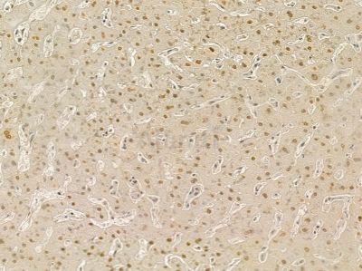 MXD4 Mouse Monoclonal Antibody - BF8669 at 1/100 staining human prostate cancer and para-carcinoma tissue by IHC-P.