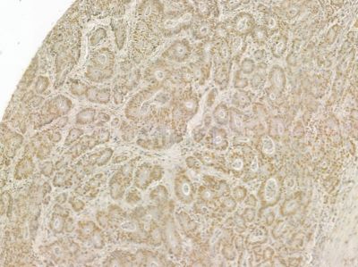 MXD4 Mouse Monoclonal Antibody - BF8669 at 1/100 staining human prostate cancer by IHC-P.