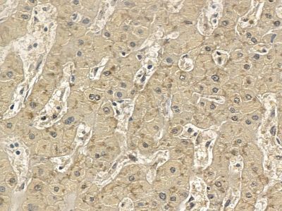SLC47A2 Mouse Monoclonal Antibody - BF8670 at 1/100 staining human prostate cancer and para-carcinoma tissue by IHC-P.