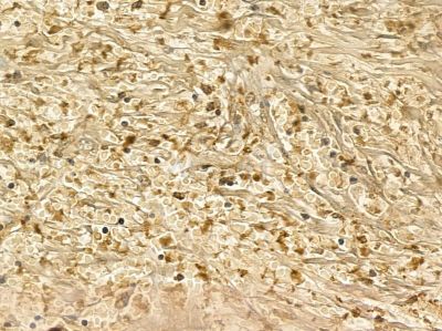 ZBTB7C Mouse Monoclonal Antibody - BF8673 at 1/100 staining human pancreatic cancer and para-carcinoma tissue by IHC-P.