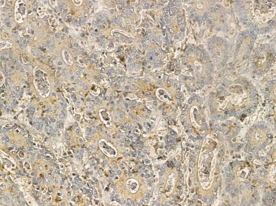 ZBTB7C Mouse Monoclonal Antibody - BF8673 at 1/100 staining human colorectal cancer by IHC-P.