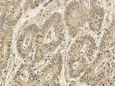 ANP32E Mouse Monoclonal Antibody - BF8676 at 1/100 staining human colorectal cancer by IHC-P.