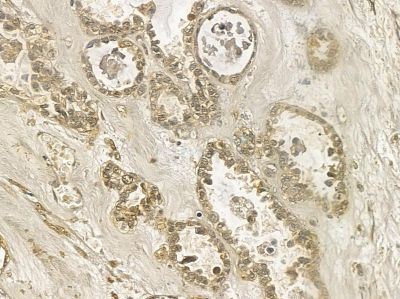 ANP32E Mouse Monoclonal Antibody - BF8676 at 1/100 staining human ovarian cancer by IHC-P.