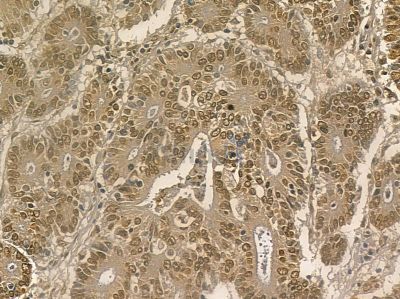 DHX32 Mouse Monoclonal Antibody - BF8683 at 1/100 staining human prostate cancer by IHC-P.