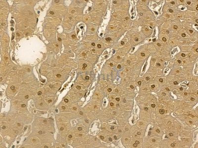 DHX32 Mouse Monoclonal Antibody - BF8683 at 1/100 staining human prostate cancer and para-carcinoma tissue by IHC-P.