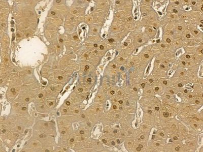 DHX32 Mouse Monoclonal Antibody - BF8683 at 1/100 staining human liver cancer and adjacent non-tumor tissue by IHC-P.