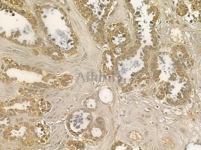TIPRL Mouse Monoclonal Antibody - BF8684 at 1/100 staining human ovarian cancer by IHC-P.