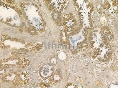 TIPRL Mouse Monoclonal Antibody - BF8684 at 1/100 staining human ovarian cancer by IHC-P.