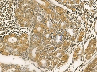 GUCA1A Mouse Monoclonal Antibody - BF8693 at 1/100 staining human ovarian cancer by IHC-P.