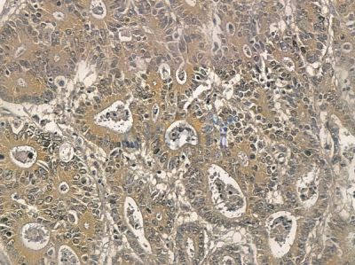 HNRNPA1L2 Mouse Monoclonal Antibody - BF8695 at 1/100 staining human colorectal cancer by IHC-P.