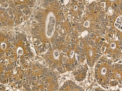 MOGAT2 Mouse Monoclonal Antibody - BF8702 at 1/100 staining human prostate cancer by IHC-P.