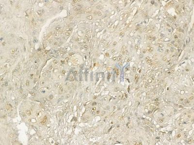 PCGF1 Mouse Monoclonal Antibody - BF8704 at 1/100 staining human esophageal cancer and adjacent non-tumor tissue by IHC-P.