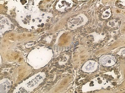 NSMAF Mouse Monoclonal Antibody - BF8710 at 1/100 staining human ovarian cancer by IHC-P.