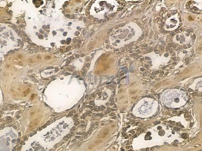 NSMAF Mouse Monoclonal Antibody - BF8710 at 1/100 staining human ovarian cancer by IHC-P.