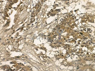 LIMS2 Mouse Monoclonal Antibody - BF8713 at 1/100 staining human colorectal cancer by IHC-P.