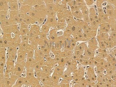 ZFX Mouse Monoclonal Antibody - BF8722 at 1/100 staining human liver cancer by IHC-P.