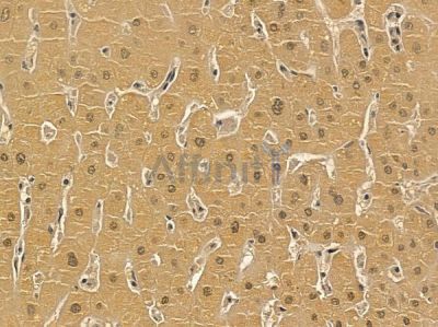ZFX Mouse Monoclonal Antibody - BF8722 at 1/100 staining human liver cancer by IHC-P.