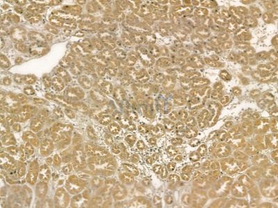 LASP1 Mouse Monoclonal Antibody - BF8727 at 1/100 staining human pancreatic cancer and para-carcinoma tissue by IHC-P.