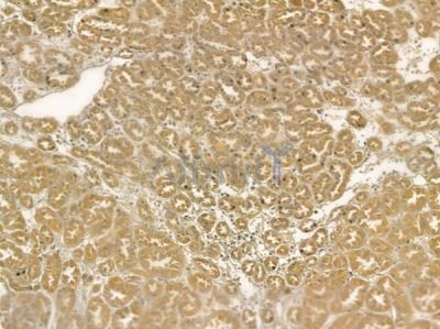 LASP1 Mouse Monoclonal Antibody - BF8727 at 1/100 staining human renal cell carcinoma by IHC-P.