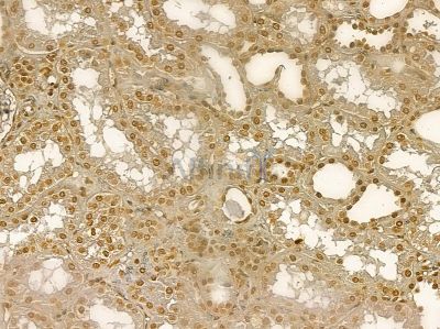C8orf4 Mouse Monoclonal Antibody - BF8735 at 1/100 staining human pancreatic cancer by IHC-P.