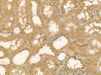 RIC3 Mouse Monoclonal Antibody - BF8739 at 1/100 staining human pancreatic cancer by IHC-P.