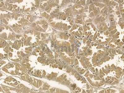 ZFAND3 Mouse Monoclonal Antibody - BF8757 at 1/100 staining human renal cell carcinoma by IHC-P.