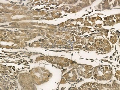 KLHL4 Mouse Monoclonal Antibody - BF8766 at 1/100 staining human ovarian cancer by IHC-P.