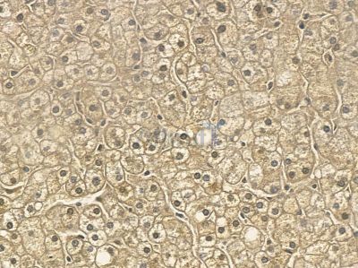 RUFY3 Mouse Monoclonal Antibody - BF8772 at 1/100 staining human ovarian cancer by IHC-P.