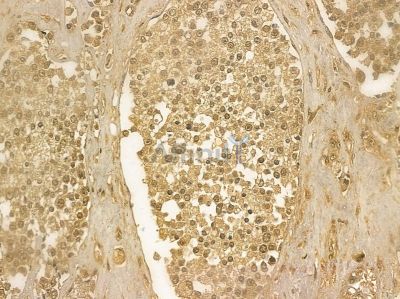 DBC1 Mouse Monoclonal Antibody - BF8877 at 1/100 staining human prostate cancer and para-carcinoma tissue by IHC-P.