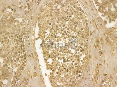 DBC1 Mouse Monoclonal Antibody - BF8877 at 1/100 staining human prostate carcinoma by IHC-P.