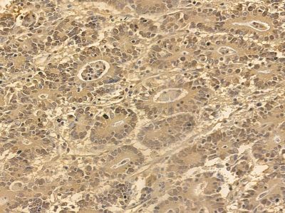 FOXO4 Mouse Monoclonal Antibody - BF8916 at 1/100 staining human prostate cancer by IHC-P.