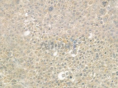 CACNA1G Antibody - DF10014 at 1/100 staining human hepatocellular carcinoma by IHC-P.