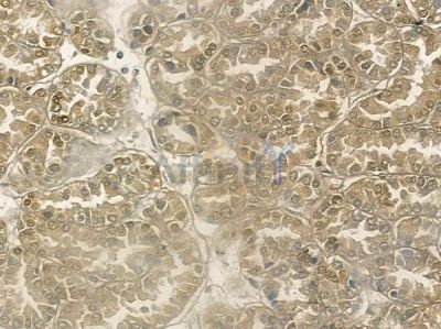 ZNF295 Antibody - DF10017 at 1/100 staining human renal cell carcinoma by IHC-P.