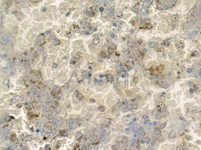 ATOH8 Antibody - DF10047 at 1/100 staining human melanoma by IHC-P.
