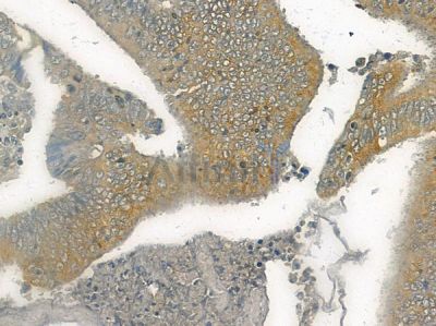 TRIM68 Antibody - DF10055 at 1/100 staining human colon carcinoma by IHC-P.