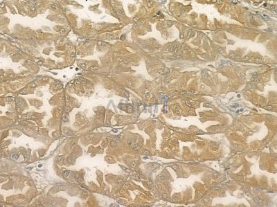 MYCBP Antibody - DF10076 at 1/100 staining human pancreatic cancer and para-carcinoma tissue by IHC-P.
