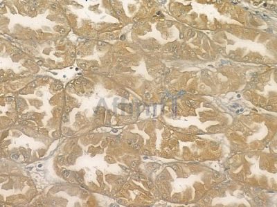 MYCBP Antibody - DF10076 at 1/100 staining human renal cell carcinoma by IHC-P.