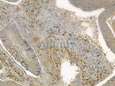 COX7B Antibody - DF10093 at 1/100 staining human colon carcinoma by IHC-P.